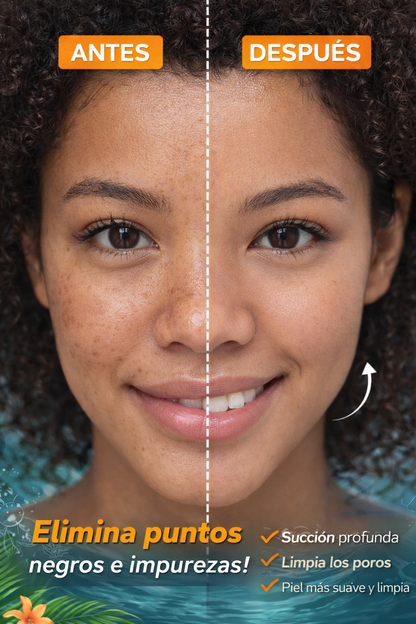 Limpiador Facial Removedor de Puntos Negros con Succión Profunda